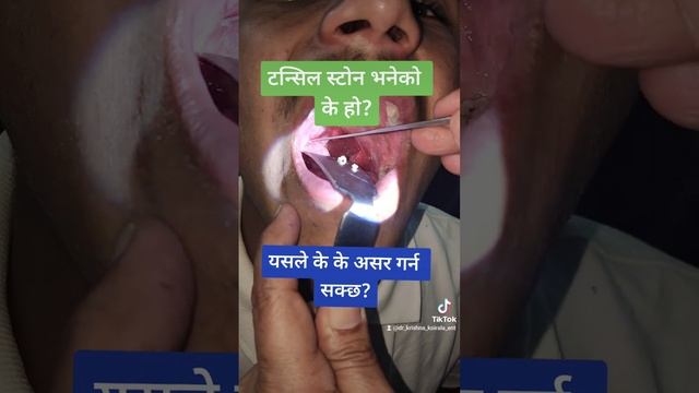 Tonsil Stones (Tonsillolith) // Tonsillar Debris Removal // Dr Krishna Koirala // Pokhara