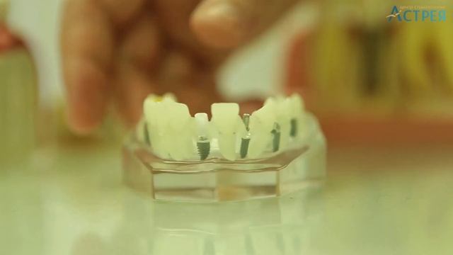 Сколько стоит имплантация зубов смотреть онлайн