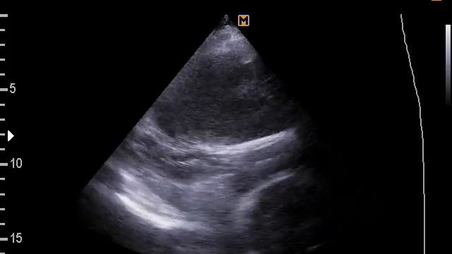 Жидкость в плевральной полости на УЗИ легких(16-5-17) смотреть онлайн