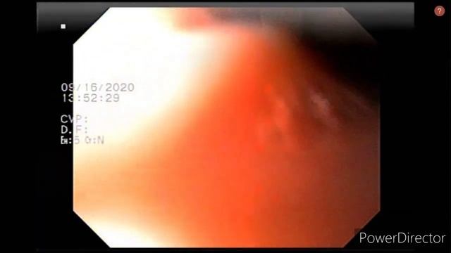 Viendo por dentro el esófago, estómago y duodeno con el Dr. Marcelo Rossetti смотреть онлайн
