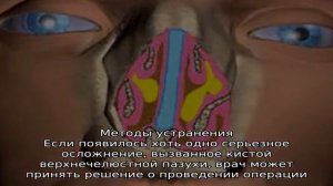 Механизм образования и последствия кисты в гайморовой пазухе