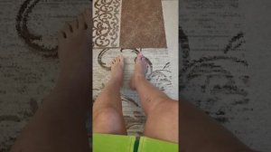 Перелом голени, перелом большой берцовой через 2 месяца, остеосинтез, БИОС, штифт в голени