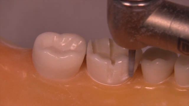 All Ceramic Crown Prep In 5 Minutes| The 5x5x5 Technique