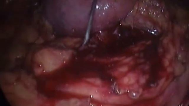 Laparoscopic Y-Pyeloplasty (R. Hydronephrosis).