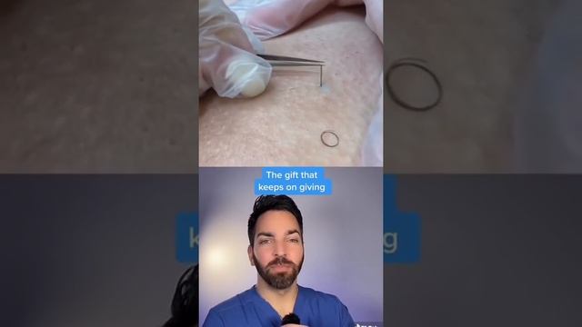 ВРОСШИЙ ВОЛОС!!!