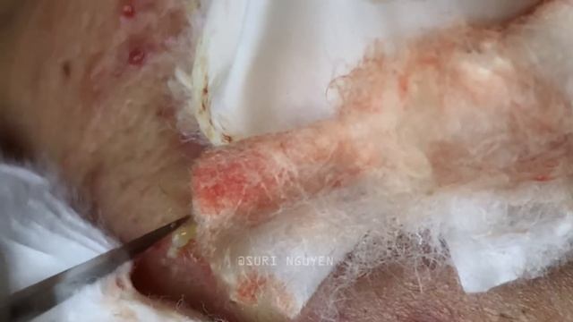 Suri Series 01: AMAZING INFLAMED BLACKHEADS POPPING | PART 3 смотреть онлайн