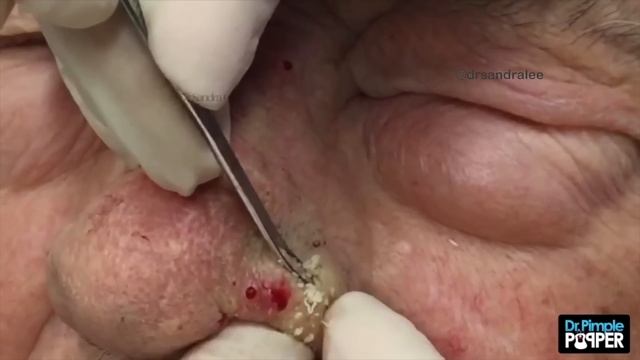 My Top 10 BEST Blackhead Pops of 2015: Part 2, #1-#3 смотреть онлайн