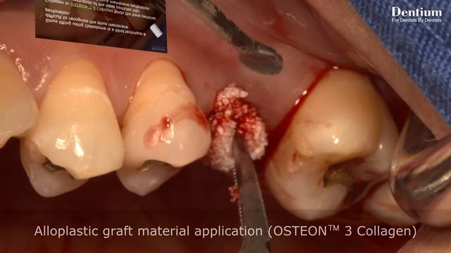 Simple sinus augmentation with Osteotome technique смотреть онлайн