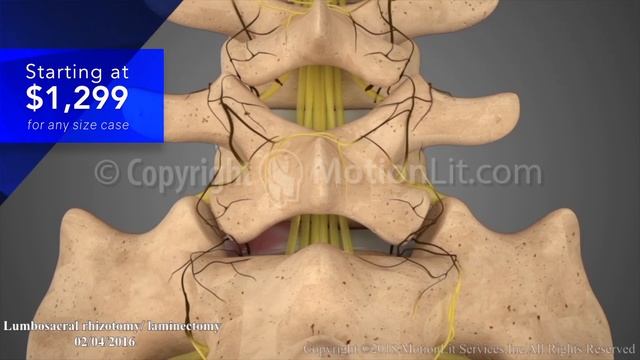 Lumbar Surgery - Laminectomy - 3D Medical Animation смотреть онлайн