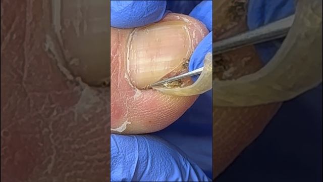 Removed a large piece of ingrown armor, and a whole piece of black mud смотреть онлайн