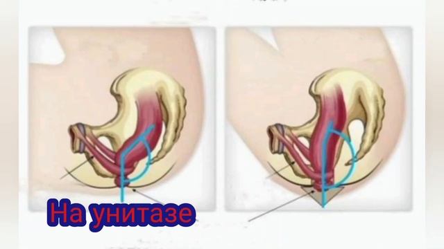 Поза для дефекации.Как какать,чтобы не было ЗАПОРА и ИНСУЛЬТА