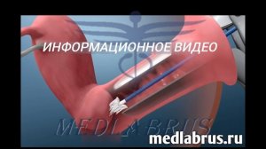 ПАП-тест: этапы процедуры и важность анализа