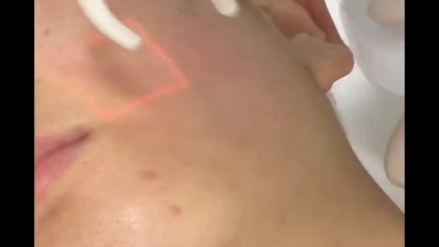 Fraction CO2 – фракционный лазер смотреть онлайн