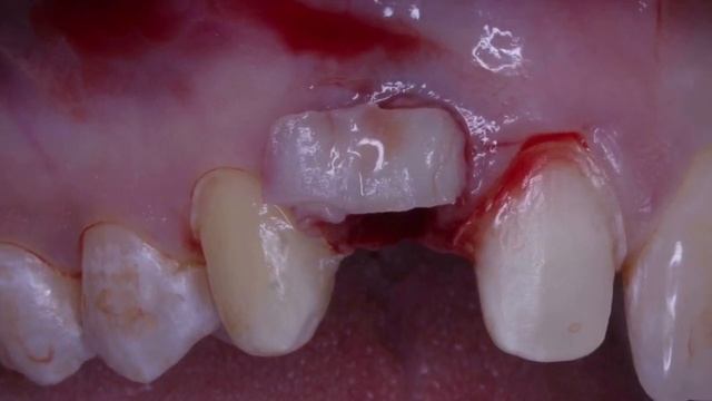 Керамические коронки , забор трансплантата , имплантация зуба , виниры , Dental Surgery, Implant