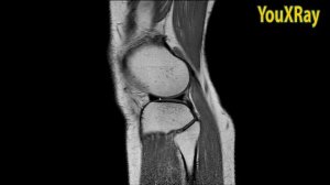 МРТ - анатомия коленного сустава