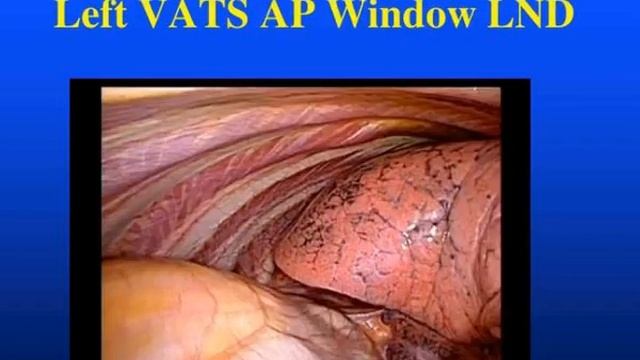 vats mediastinal lymph node dissection aats focus on lung cancer boston nov 2012 смотреть онлайн