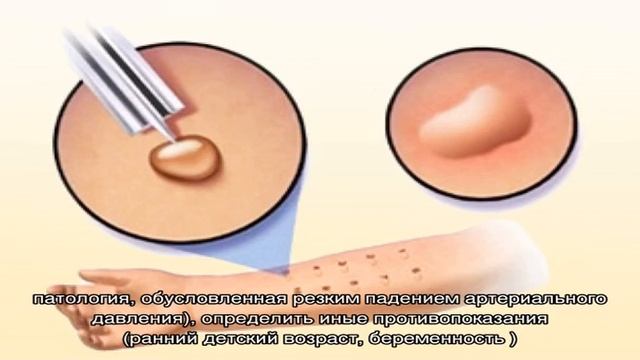 Что такое крапивница и отек Квинке и как их лечить смотреть онлайн