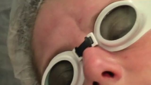 MCL 30 Dermablate - Фракциональное лазерное омоложение Er.YAG смотреть онлайн