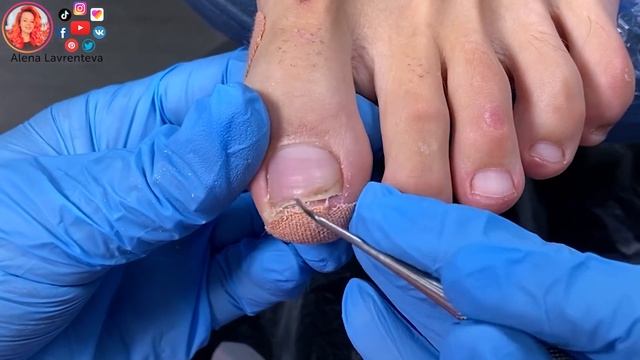 Онихолизис ногтей / Часть 3 / Носочный онихолизис смотреть онлайн