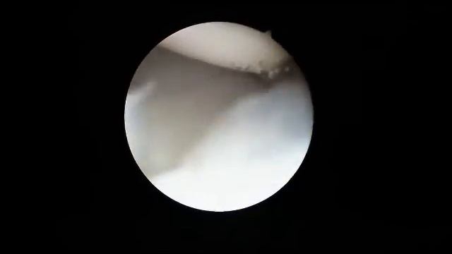 Wrist Arthroscopy смотреть онлайн