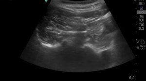 Паравертебральная блокада на поясничном уровне. Paravertebral Lumbar PL Block LATERAL APPROACH