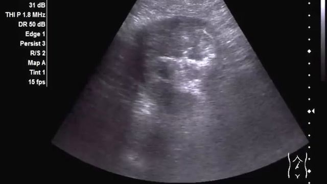 Рак желудка. смотреть онлайн