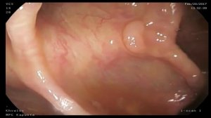 Гиперпластический полип толстой кишки. Удаление методом холодной петлевой биопсии