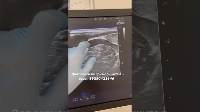 Узи вен. Находка: форма отхождения Вены. Флеболог Москва. Флеболог. Сосудистый хирург