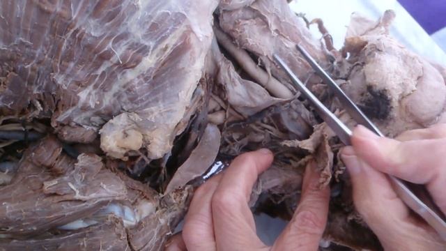 Шейное сплетение. Plexus Cervicalis