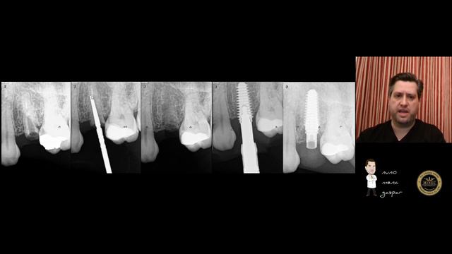 Immediate loading with R2Gate in single implants Dr. Nuno Mena Gaspar смотреть онлайн