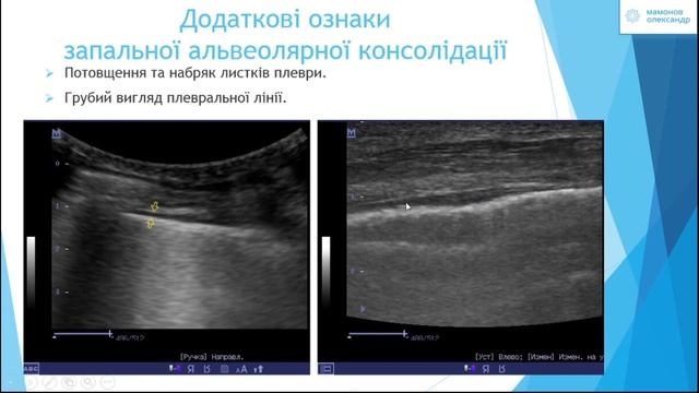 Вебінар з УЗД легень та плевральних порожнин, Мамонов