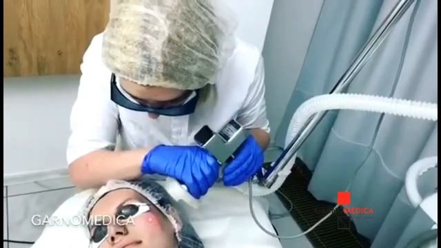 MicroLaserPeel смотреть онлайн