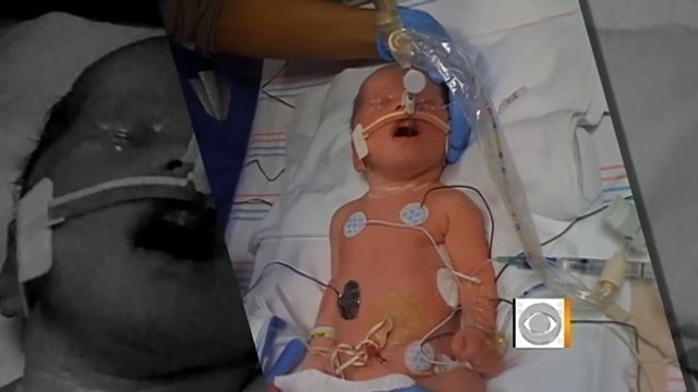 EXIT procedure saves babies' lives смотреть онлайн