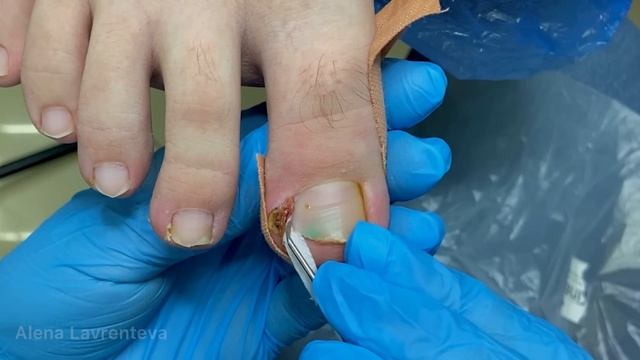 Вросший ноготь / Тампонада / Врос на ноге / Гранулема / живое мясо смотреть онлайн