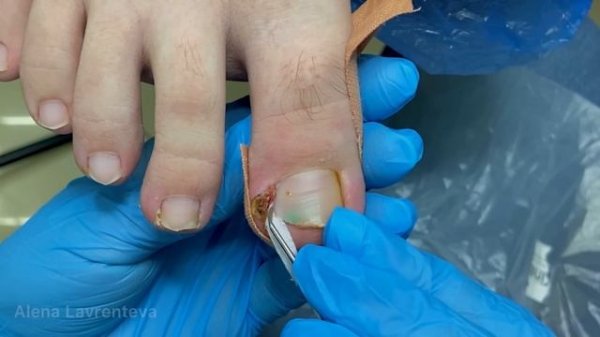 Вросший ноготь / Тампонада / Врос на ноге / Гранулема / живое мясо