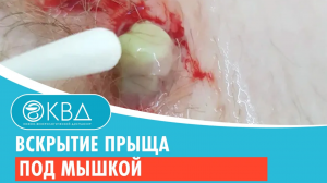 ↪ Вскрытие прыща под мышкой. Клинический случай №808