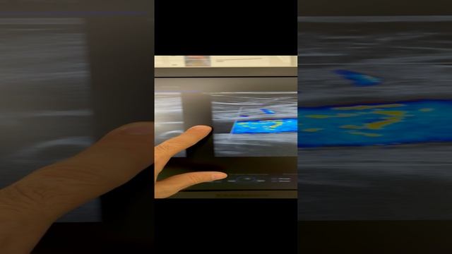 Идеальные сосуды у женщины 70 лет. Узи сосудов. Флеболог Москва. Флеболог. Сосудистый хирург смотреть онлайн