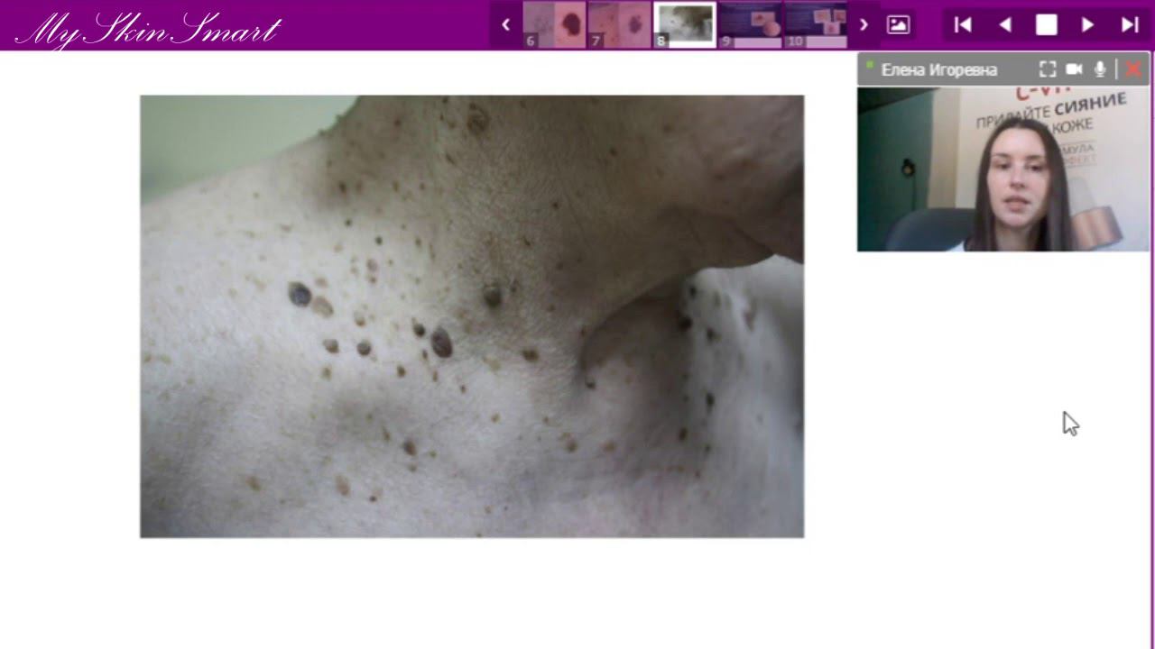 Лекция 16. Доброкачественные новообразования кожи и подкожно-жировой клетчатки смотреть онлайн