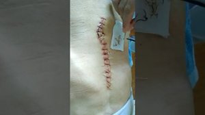 suture removal.снятие швов