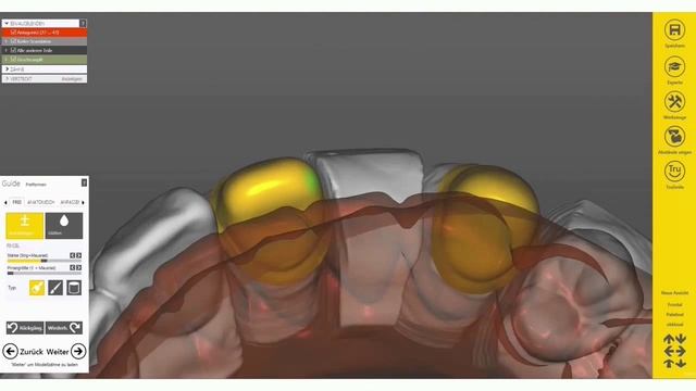 EXOCAD TUTORIALS 2015 - Modellation einer vollverblendeten Brücke by Michael Anger смотреть онлайн