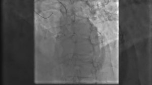 Коронарография, как проводится через лучевой доступ