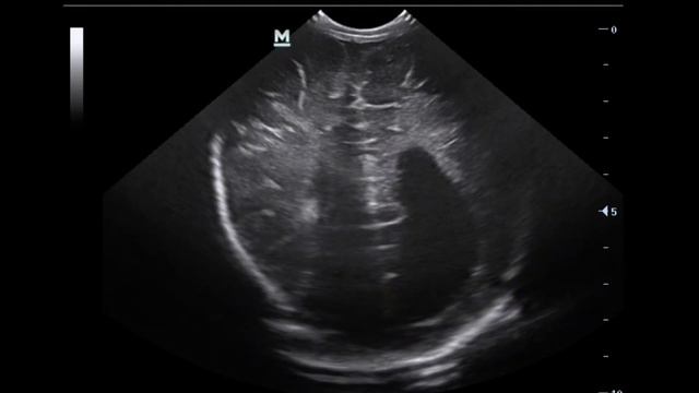Нейросонография. Киста сосудистого сплетения.