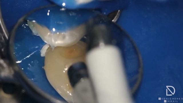 Caries Treatment. Лечение кариеса.