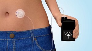 Что такое инсулиновая помпа?