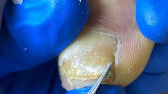 Ingrown Toenails That Have Grown Curly For Many Years, Perfectly Cured【Xue Yidao】