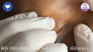 Удаление и выдавливание чёрных точек. Удаление акне. Чистка лица. Выдавливание прыщей