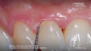 Щадящий режим работы ультразвукового скалера