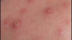 Водянистые пузырьки на теле (коже)