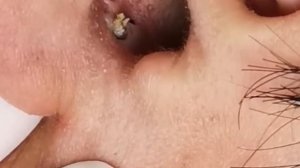 Monster Blackhead in Ear