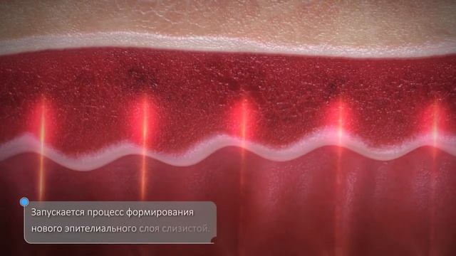 CO2-лазер для гинекологии. Манипулятор FemTouch к CO2-лазеру AcuPulse от Lumenis